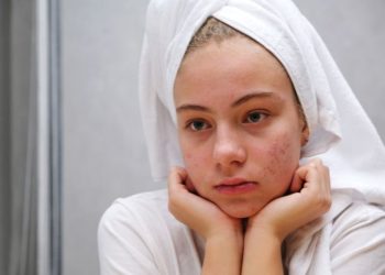 Rešenje za akne: Kako pomoći ćerki da se reši akni; zabrinuta tinejdžerka čije lice je prekriveno aknama