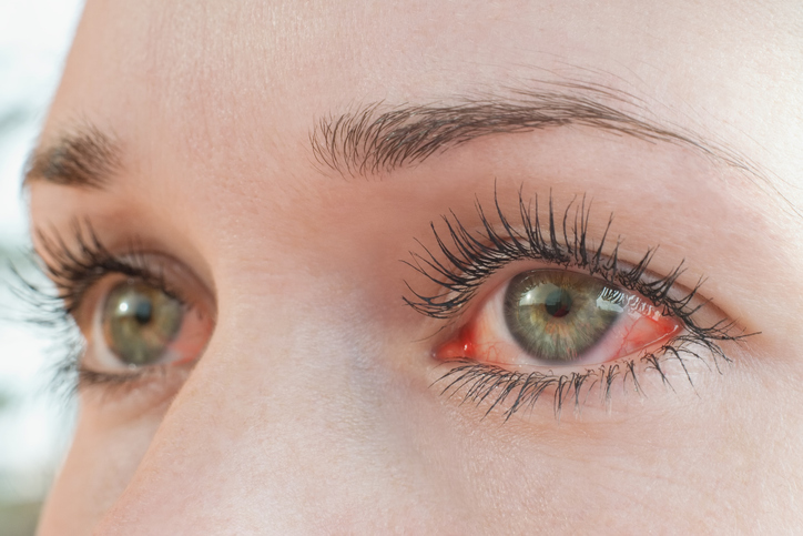 suzne oči zbog alergije